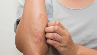 اجتماعي إعلان أجر علاج حساسية الجلد والحكة عند الاطفال hotelnewhorizon com