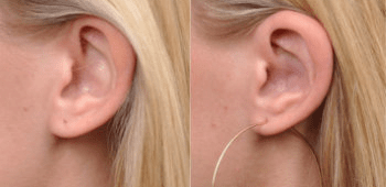 عملية تجميل لشكل الأذن